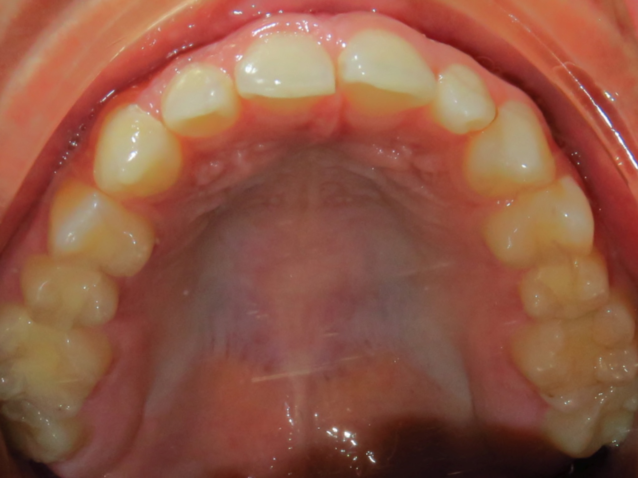 Occlusal Photo Of Maxillary Dentition The Brace Place Orthodontics