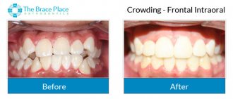 Crowding - Frontal Intraoral