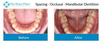 Spacing - Occlusal Photo of Mandibular Dentition