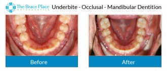 Underbite - Occlusal Photo of Mandibular Dentition