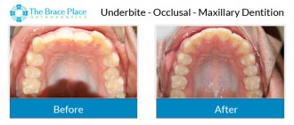 Underbite - Occlusal Photo of Maxillary Dentition