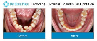 Crowding - Occlusal Photo of Mandibular Dentition