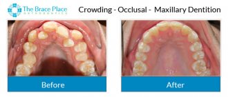 Crowding - Occlusal Photo of Maxillary Dentition