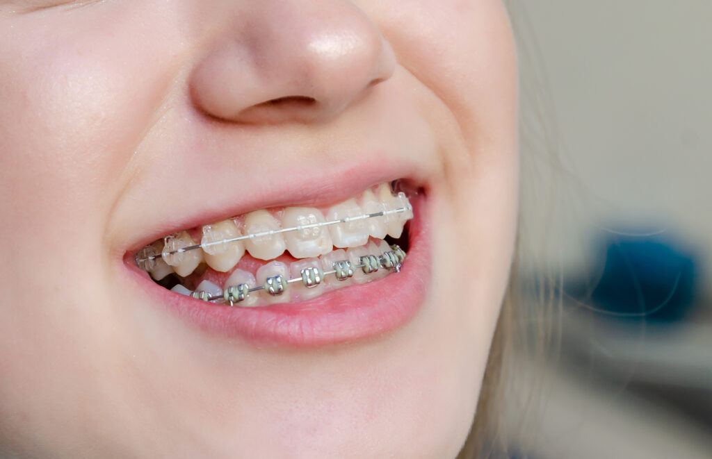 Patient wearing clear and metal braces during orthodontic treatment at The Brace Place in Irving, TX